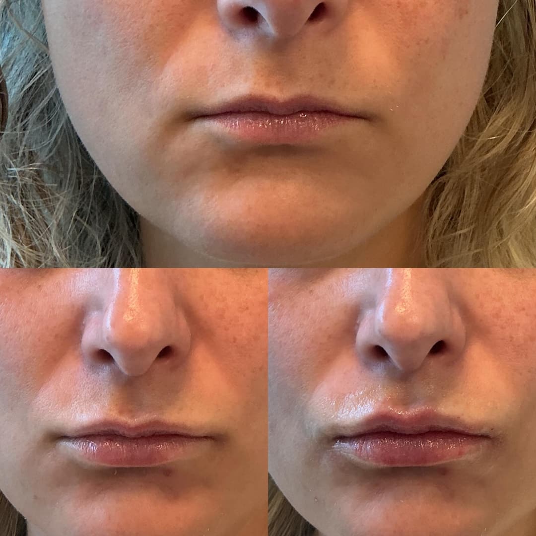 Dermal filler before and after, result 1
