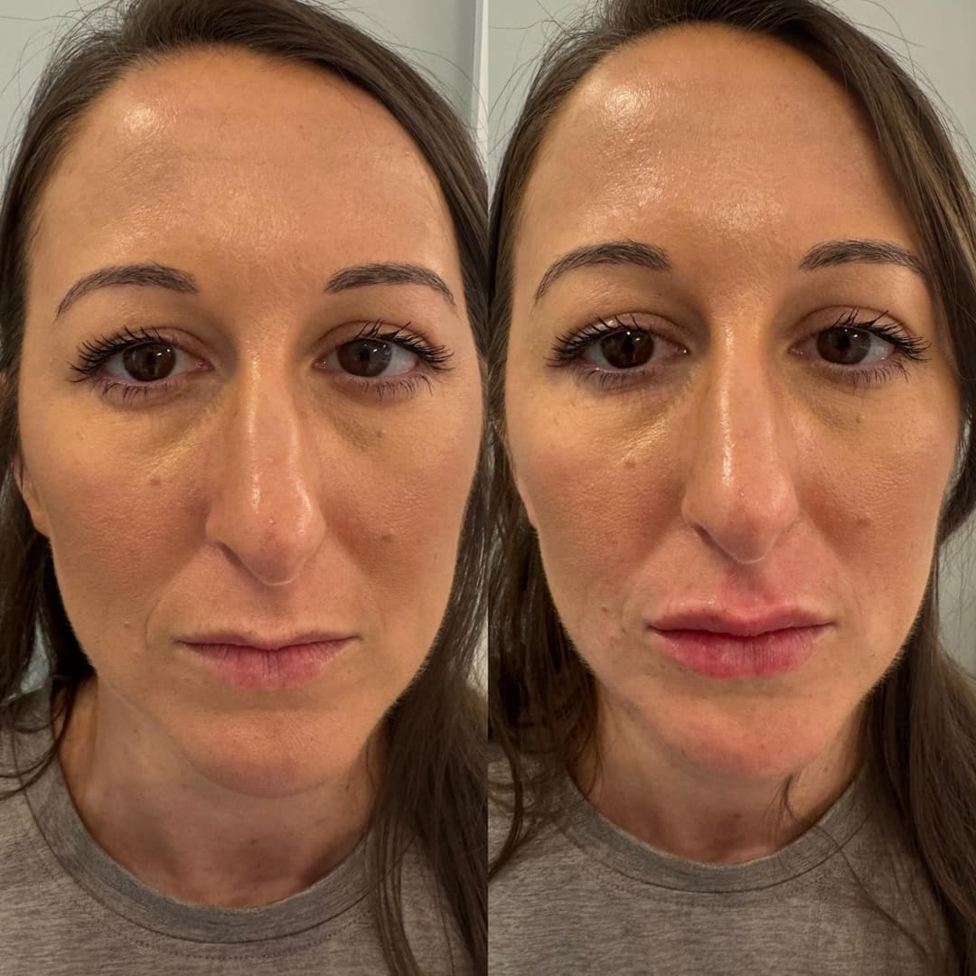 Dermal filler before and after, result 2