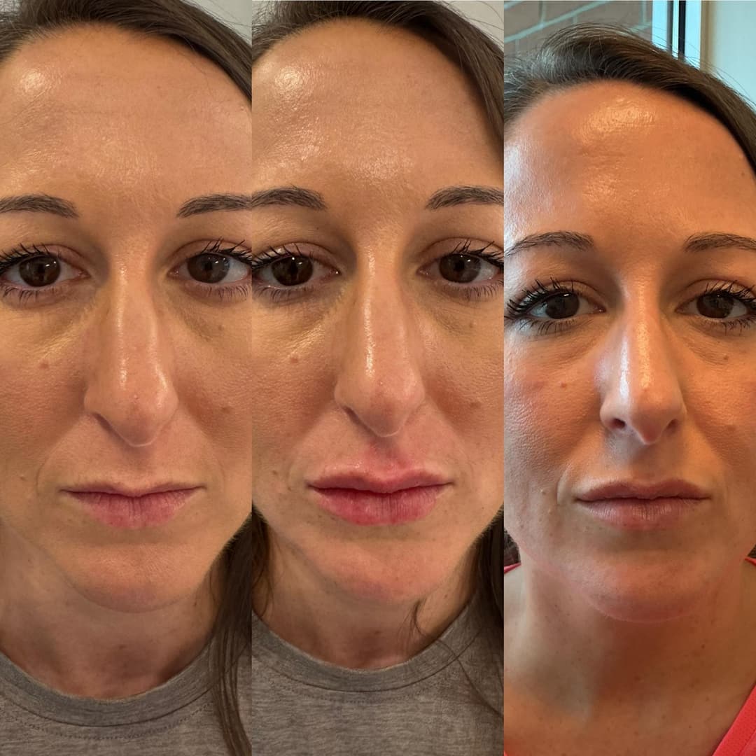 Dermal filler before and after, result 3
