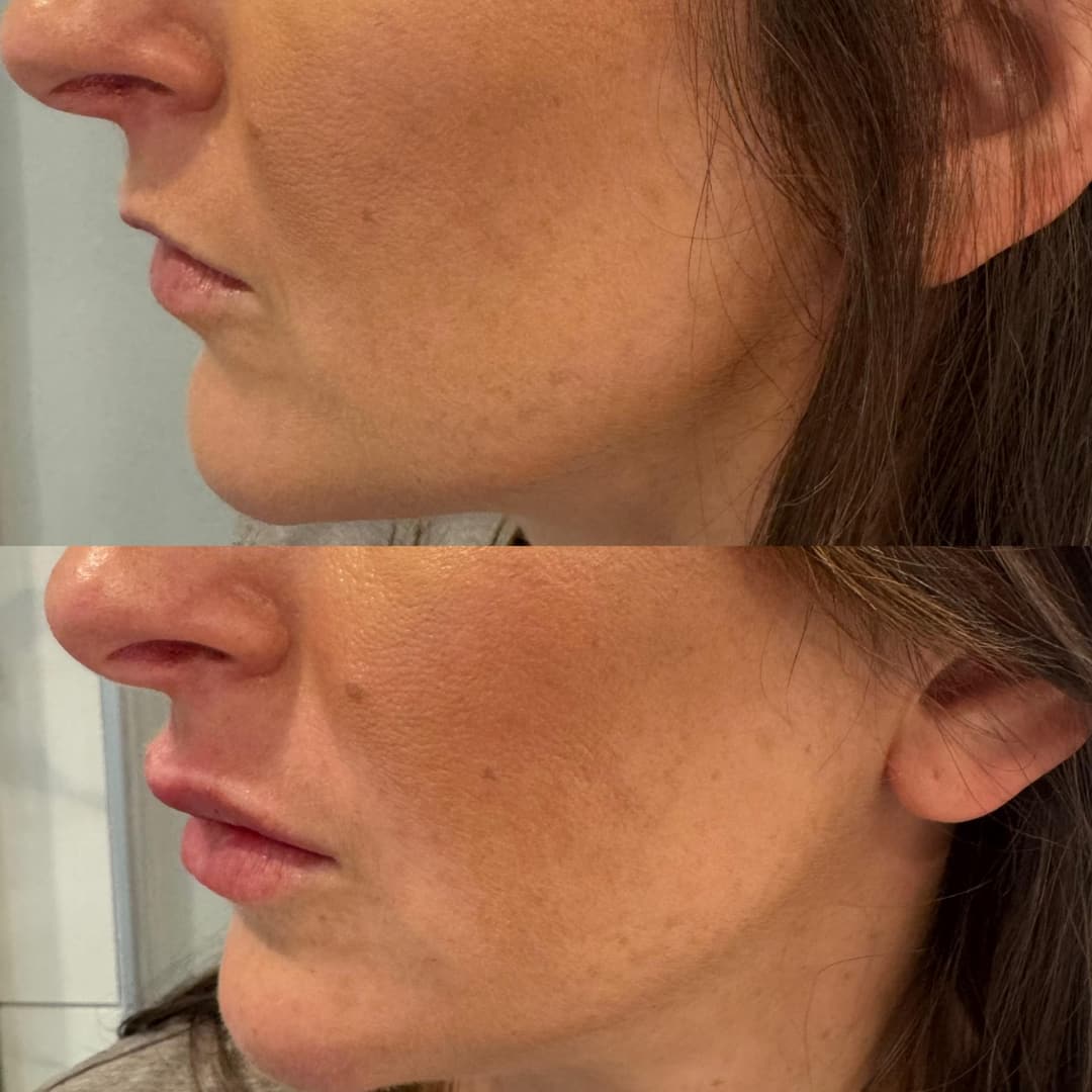 Dermal filler before and after, result 4