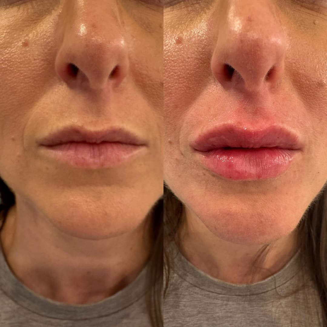 Dermal filler before and after, result 5
