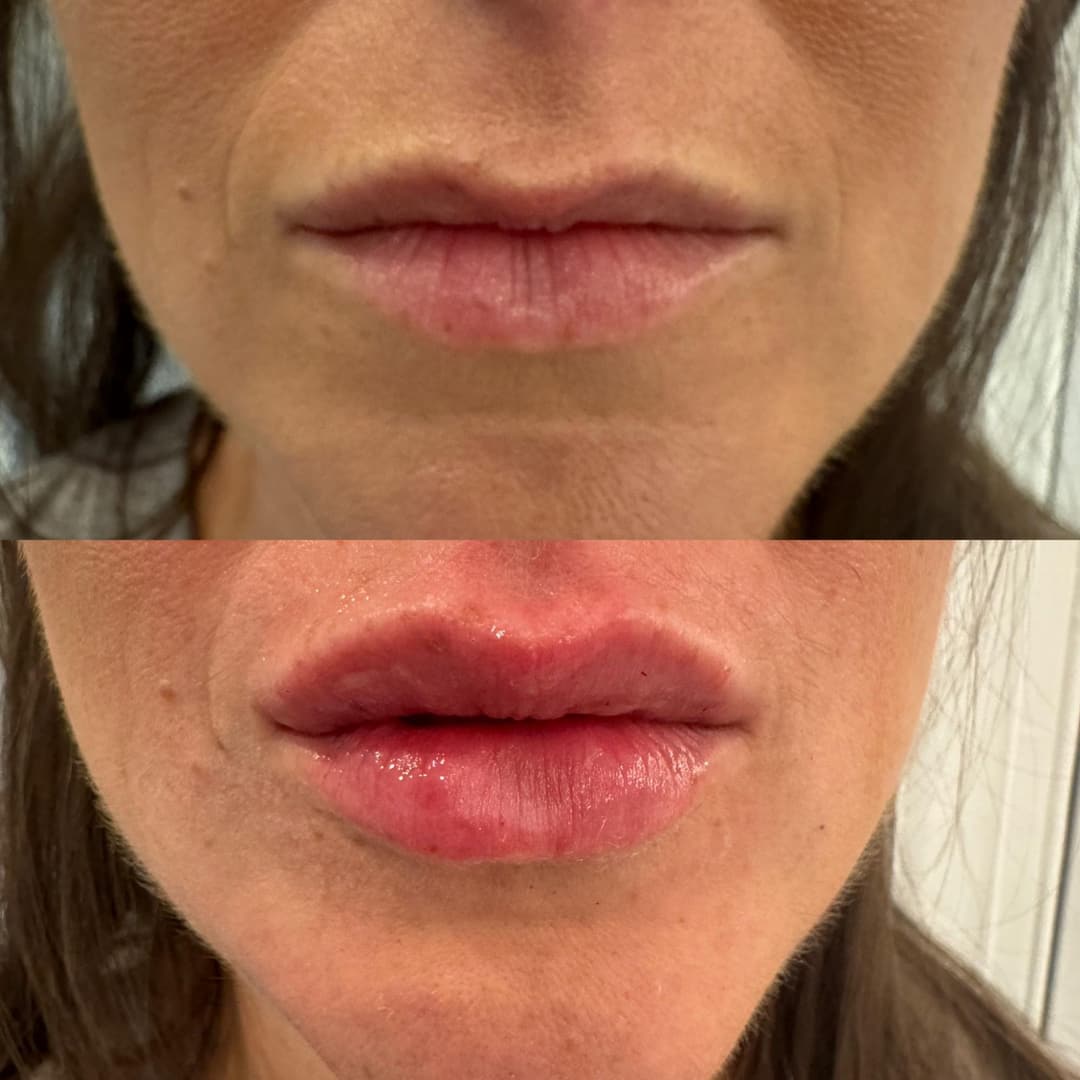 Dermal filler before and after, result 6