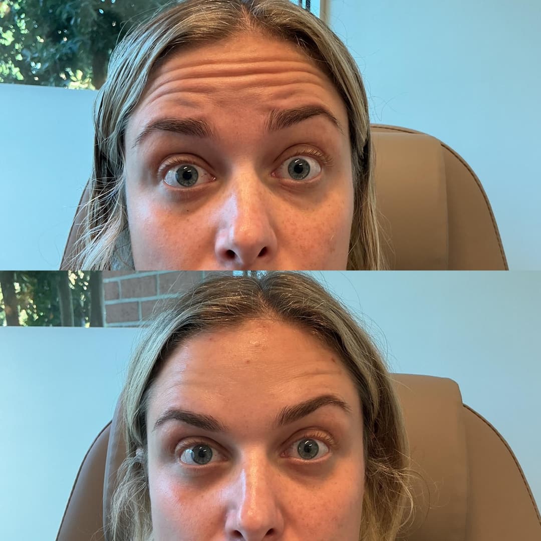 Neuromodulator before and after, result 1