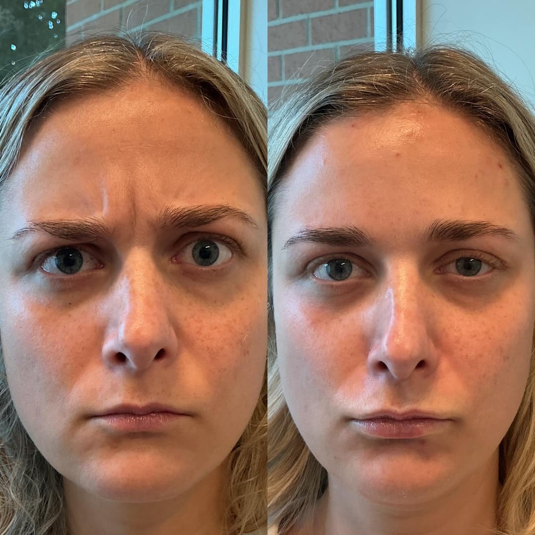 Neuromodulator before and after, result 2